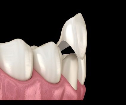 best dental veneers in jagatpura jaipur