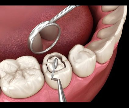 dental filling in jagatpura jaipur