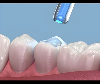 teeth restoration in jagatpura jaipur