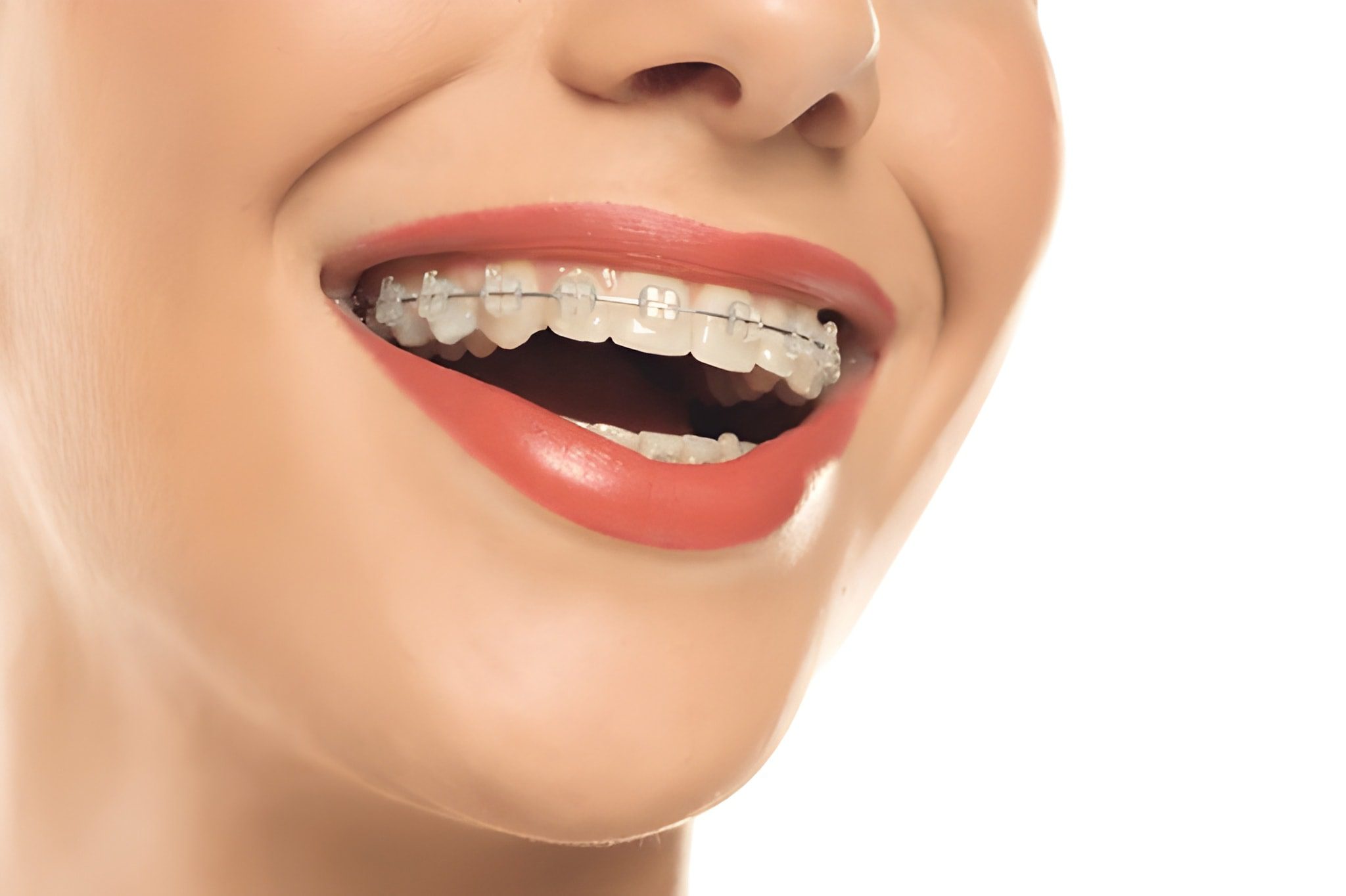 metal and ceramic braces in jagatpura jaipur