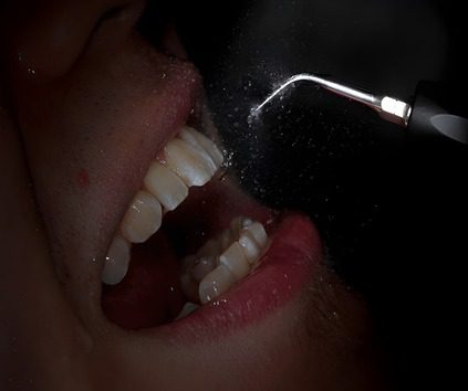 dental polishing in jagatpura jaipur