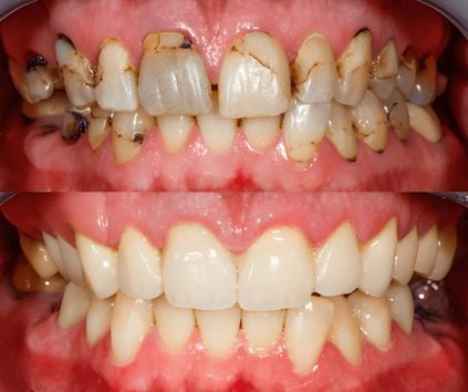 Full mouth rehabilitation in jagatpura jaipur