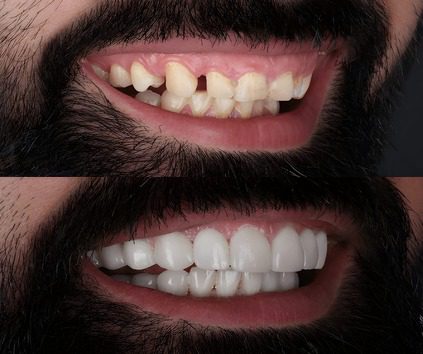 full mouth rehabilitation in jagatpura jaipur