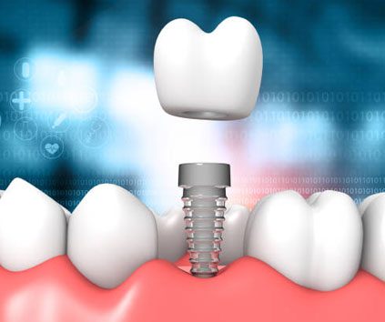 best dental implants in jagatpura jaipur