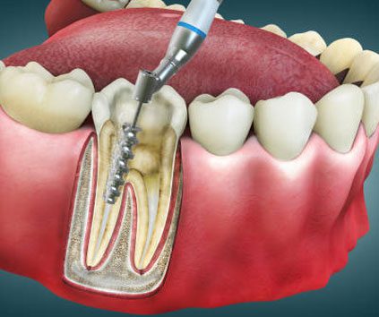 best dentist for rct in jagatpura jaipur