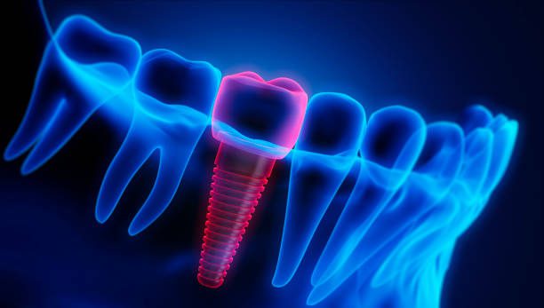 best dental implant clinic in jagatpura jaipur